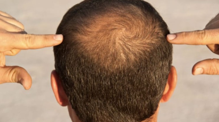 गंजी खोपड़ी पर भी उग सकते हैं नए बाल, बस नारियल तेल में ये चीज मिलाकर हफ्ते में 3 बार लगाएं और देखें कमाल