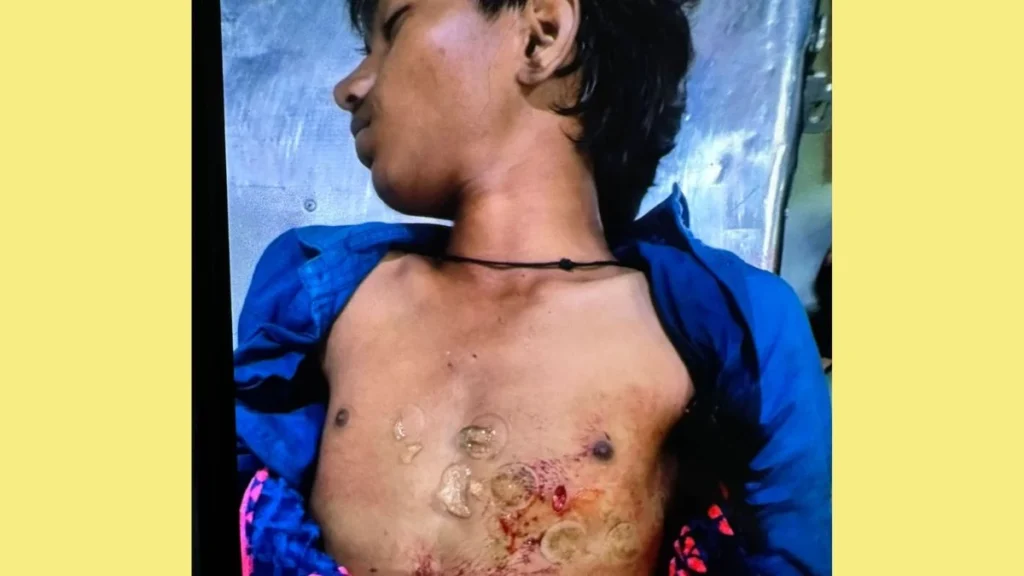 हेयर स्टाइल को लेकर चल रहा था विवाद… नाबालिग ने दोस्त की छाती में घुसा दी लोहे की रॉड, मौत