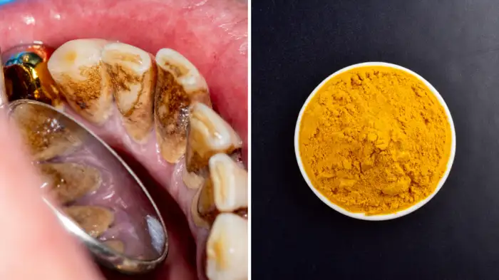 डॉक्टर रोबिन ने बताया दांतों में लगे पायरिया के लिए देसी मंजन, किन 4 चीज से बनेगा?